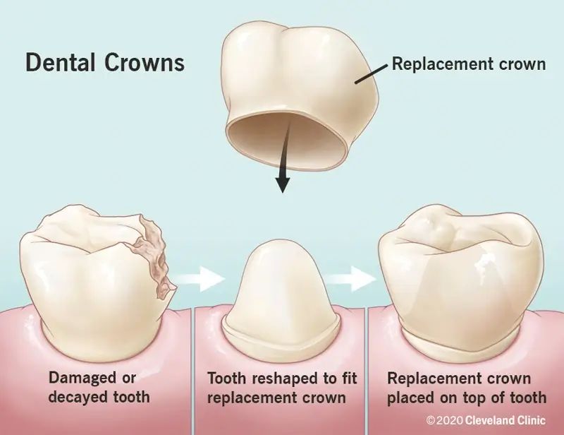 Tooth Crown
